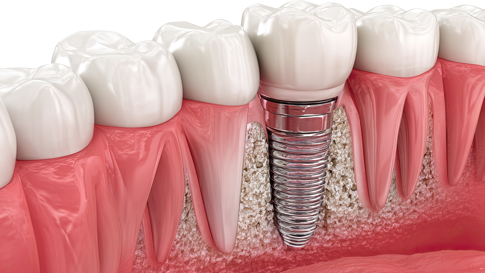 Soluciones de envasado para Implantología Dental